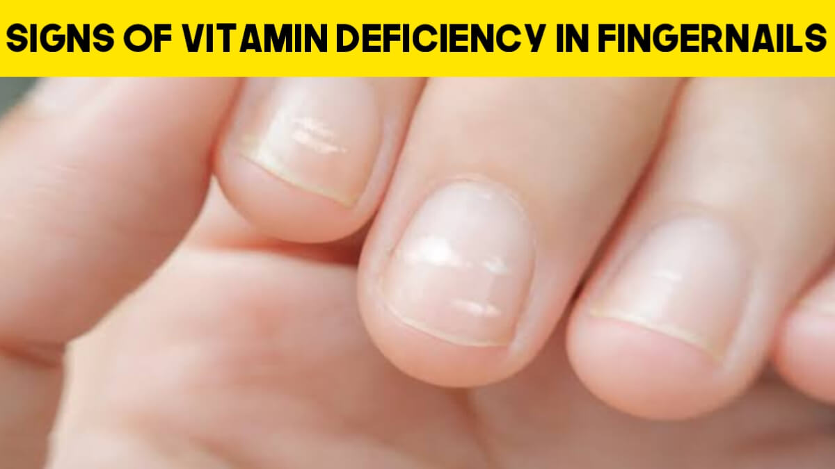 Signs Of Vitamin Deficiency In Fingernails