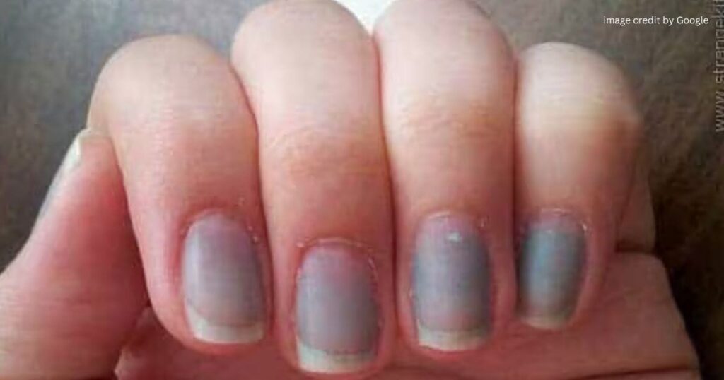 Signs Of Vitamin Deficiency In Fingernails