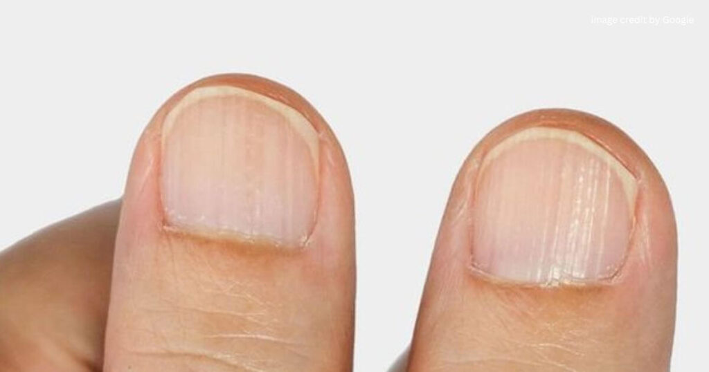 Signs Of Vitamin Deficiency In Fingernails