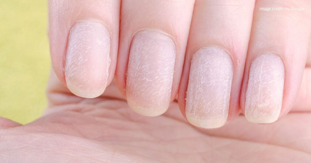 Signs Of Vitamin Deficiency In Fingernails