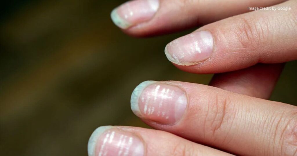 Signs Of Vitamin Deficiency In Fingernails