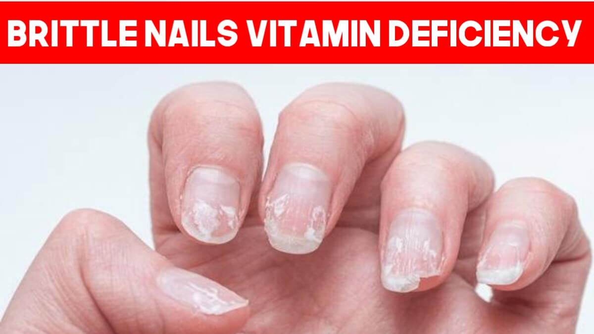 Brittle Nails Vitamin Deficiency