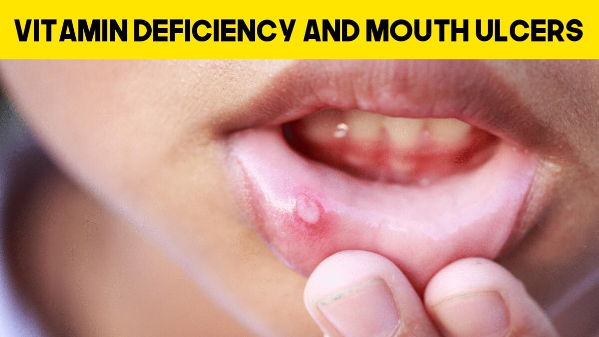 Vitamin Deficiency And Mouth Ulcers