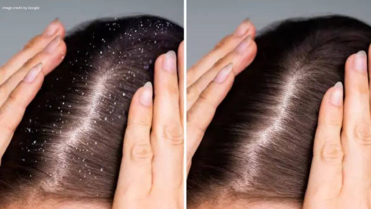 Dandruff Treatment At Home In Hindi