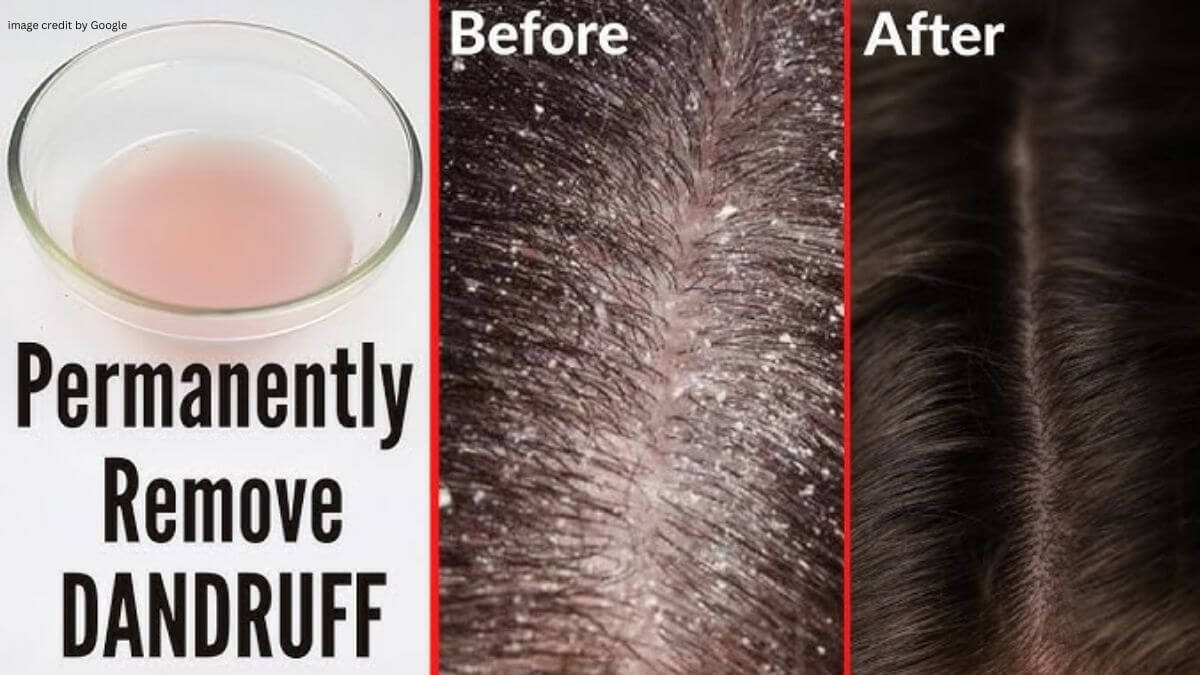 How To Get Rid Of Dandruff Permanently