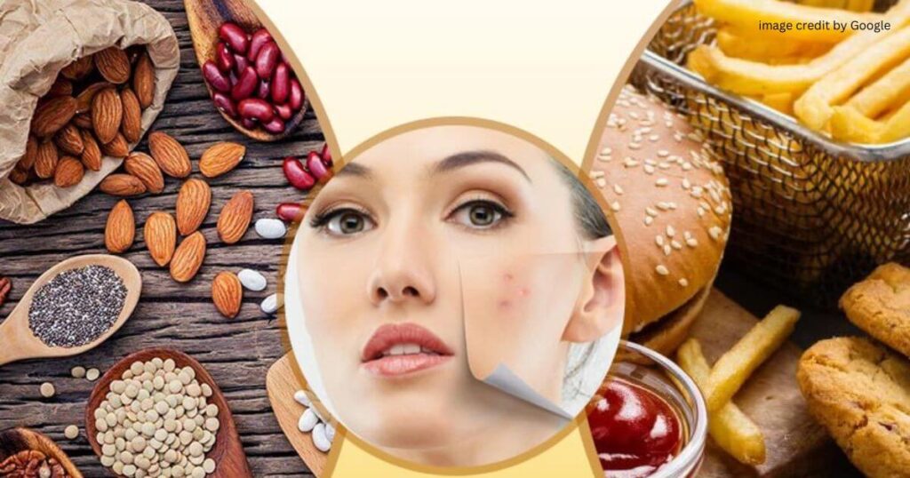 Why Does Oily Food Cause Pimples