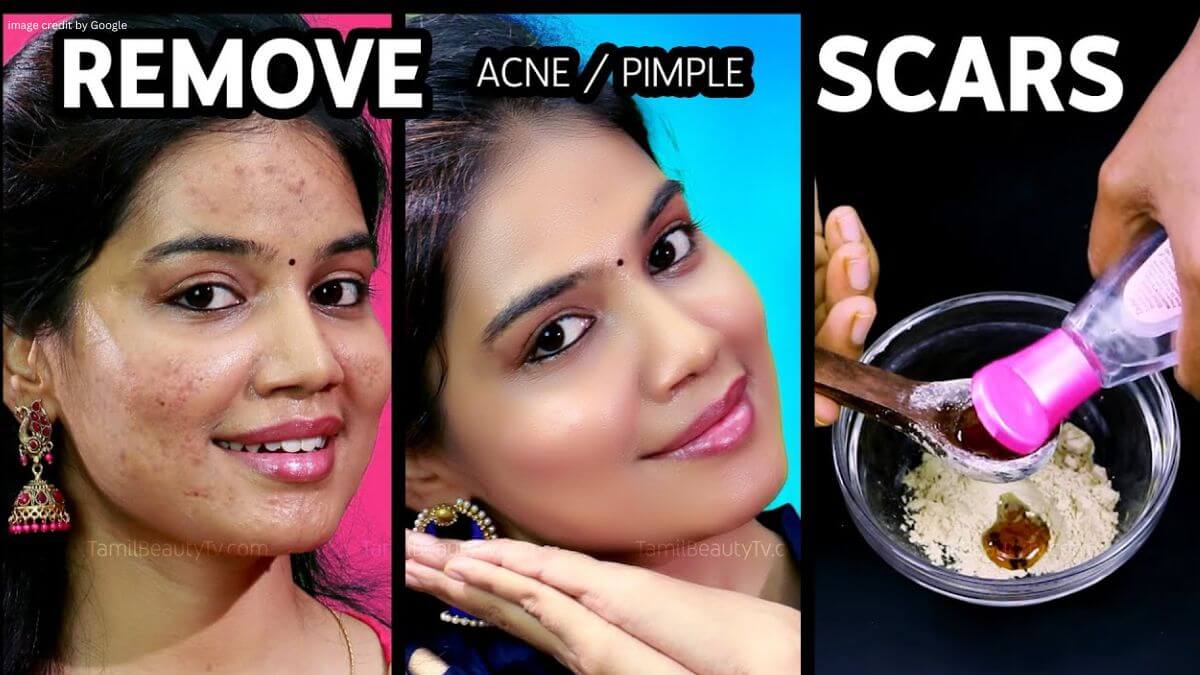 How To Remove Pimples Naturally And Permanently