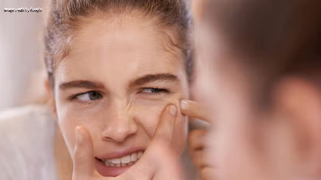 How To Get Rid Of Pimples On Face