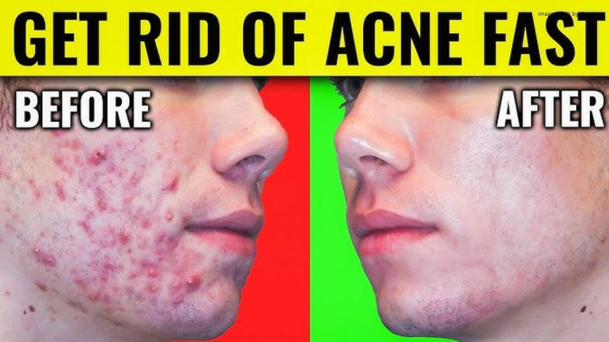 How To Get Rid Of Pimples On Face