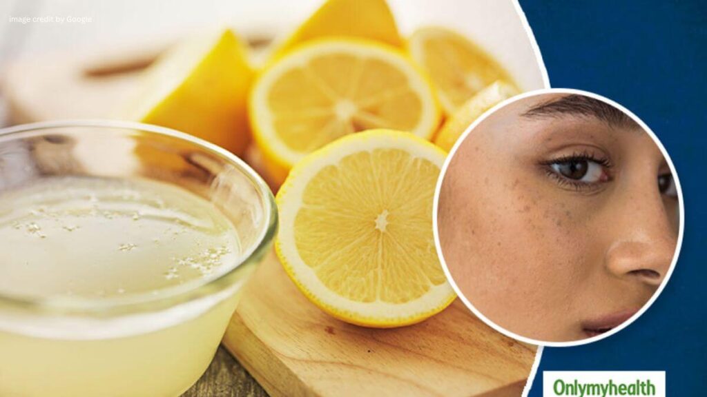 Home Remedies For Pimple Marks