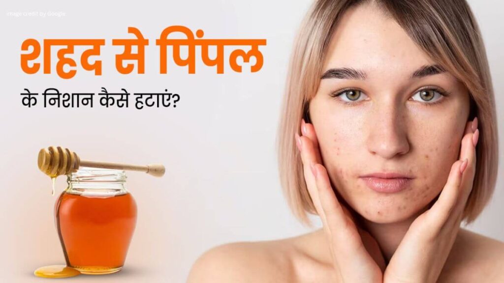 Home Remedies For Pimple Marks