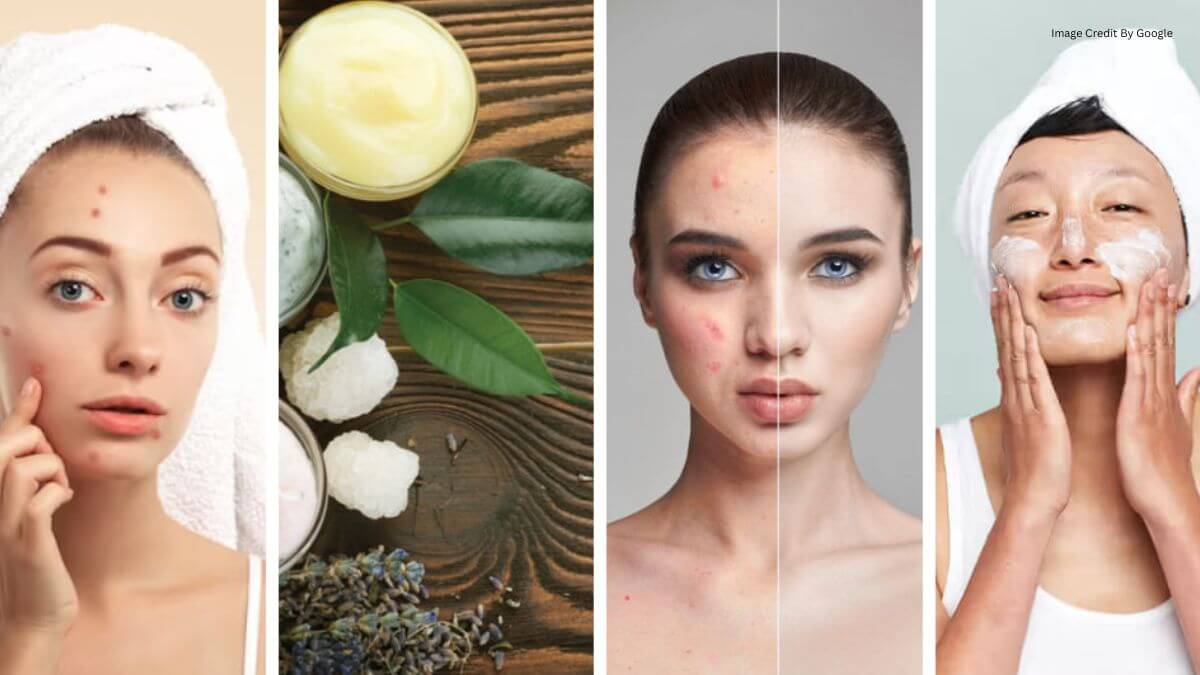 Top 10 Home Remedies For Pimples For Oily Skin