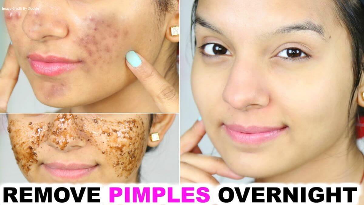 How To Remove Pimples Overnight