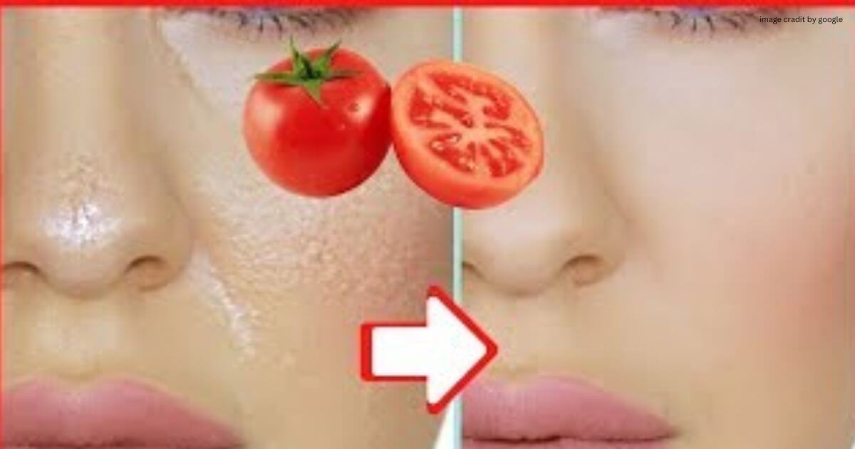 How To Get Rid Of Oily Skin Naturally