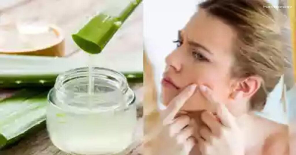 How To Remove Pimples Overnight At Home Naturally