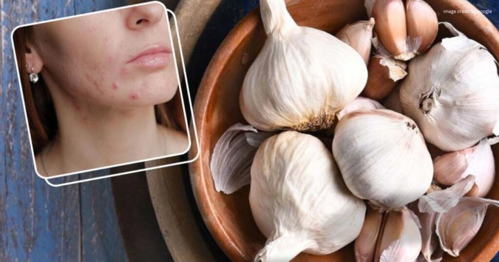 How To Remove Pimples Overnight At Home Naturally