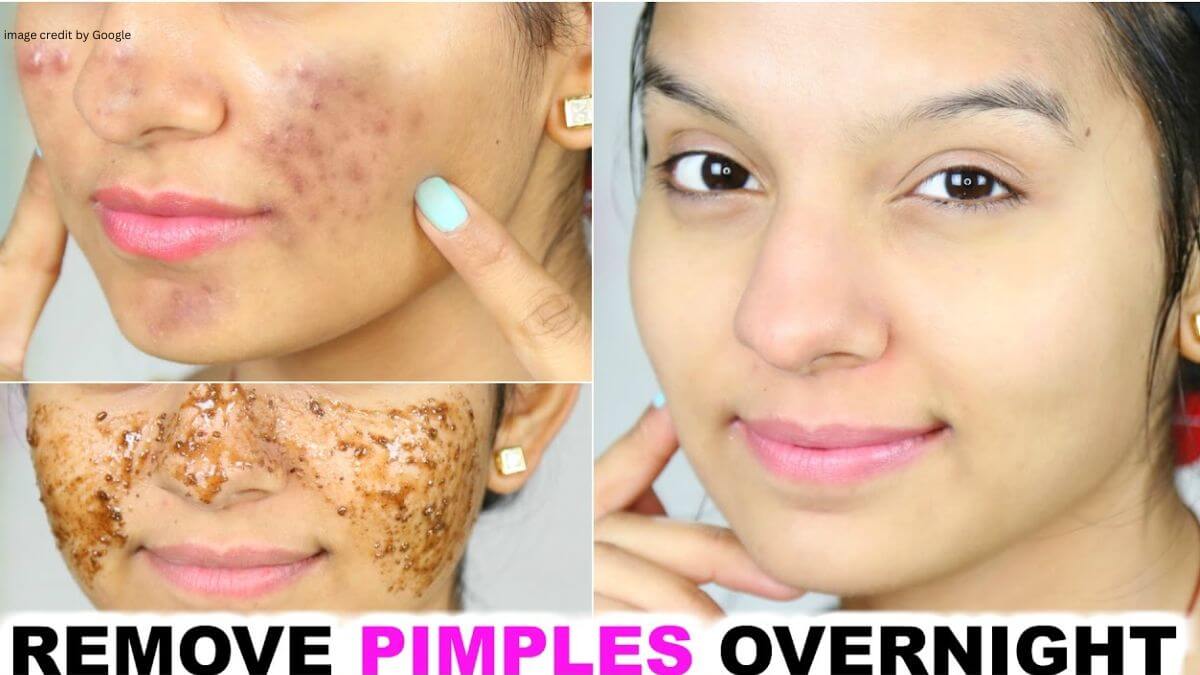 How To Remove Pimples Overnight