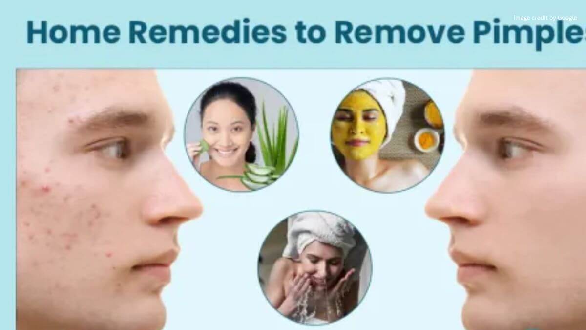 How To Remove Pimples Overnight At Home Naturally