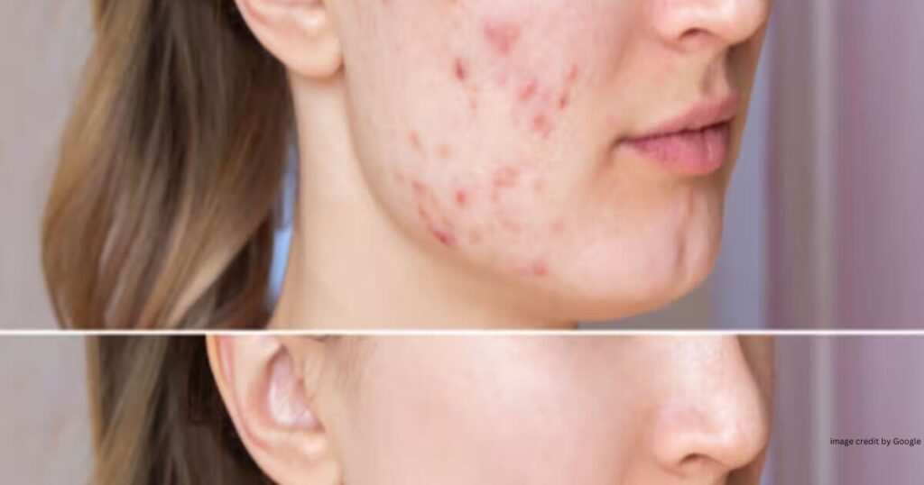 How To Remove Pimples Overnight With Toothpaste