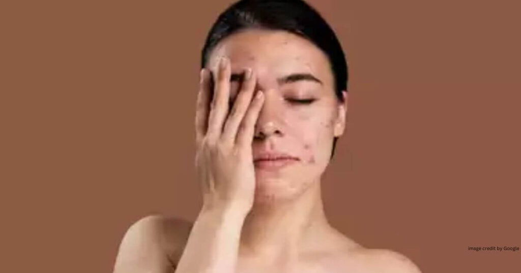 How To Remove Pimples Overnight With Toothpaste