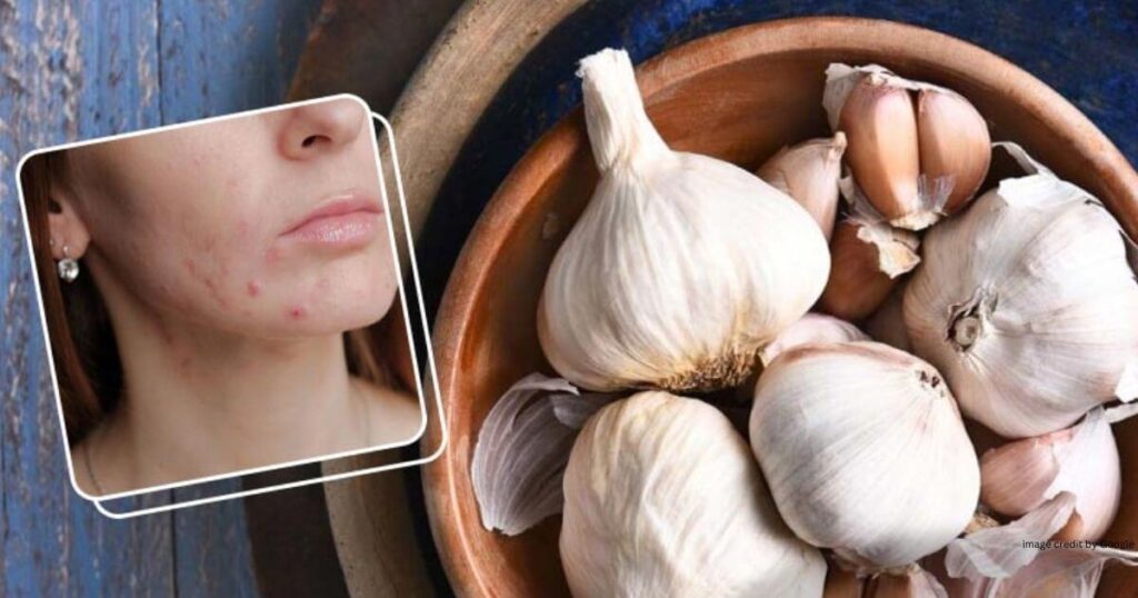 How To Remove Pimples Overnight Homemade