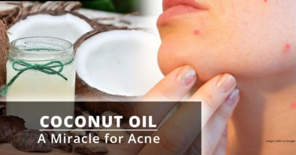 How To Remove Pimples Overnight Homemade