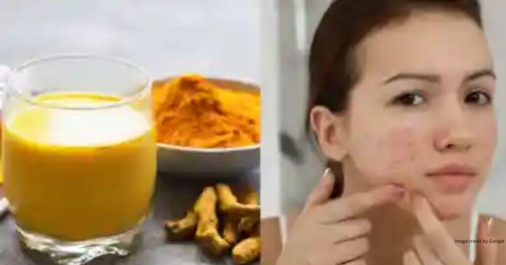 How To Remove Pimples Overnight Homemade