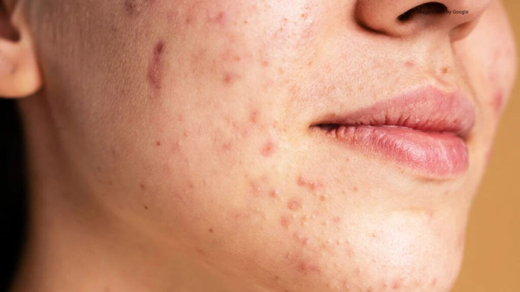 Honey On Pimples Overnight