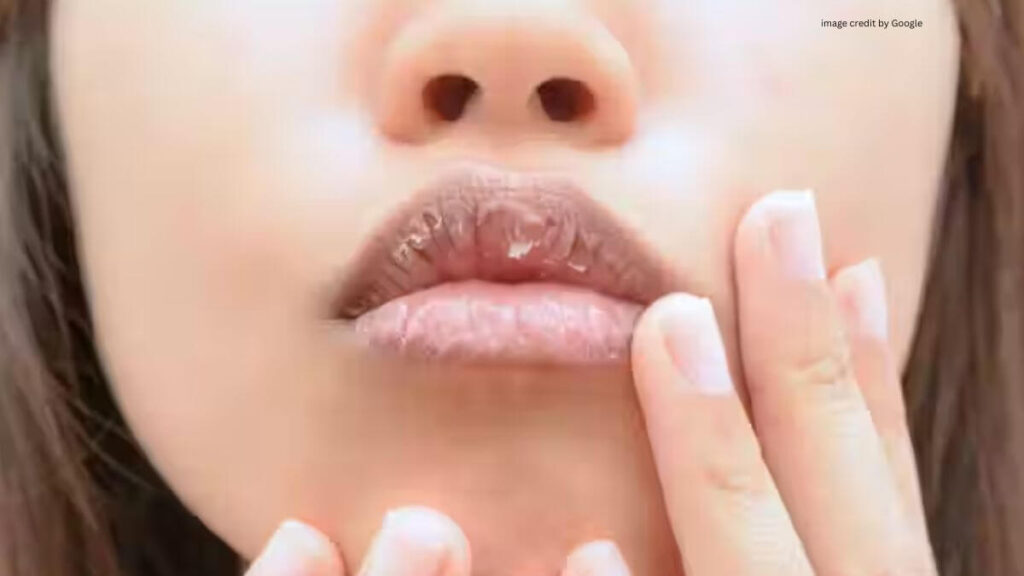 Honey On Pimples Overnight