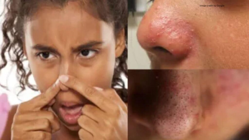 Honey On Pimples Overnight