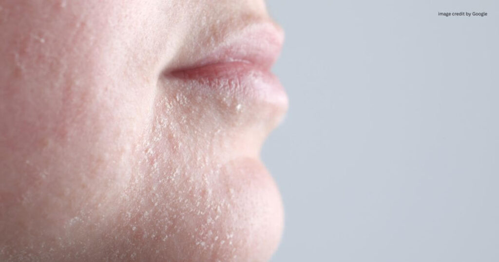 How To Treat Dry Skin On Face