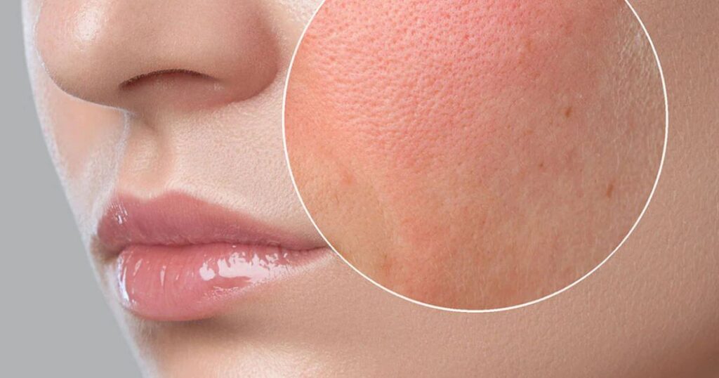How To Treat Dry Skin On Face For Men