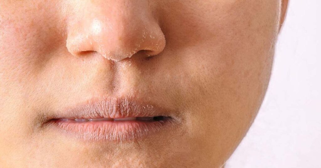 How To Treat Dry Skin On Face For Men
