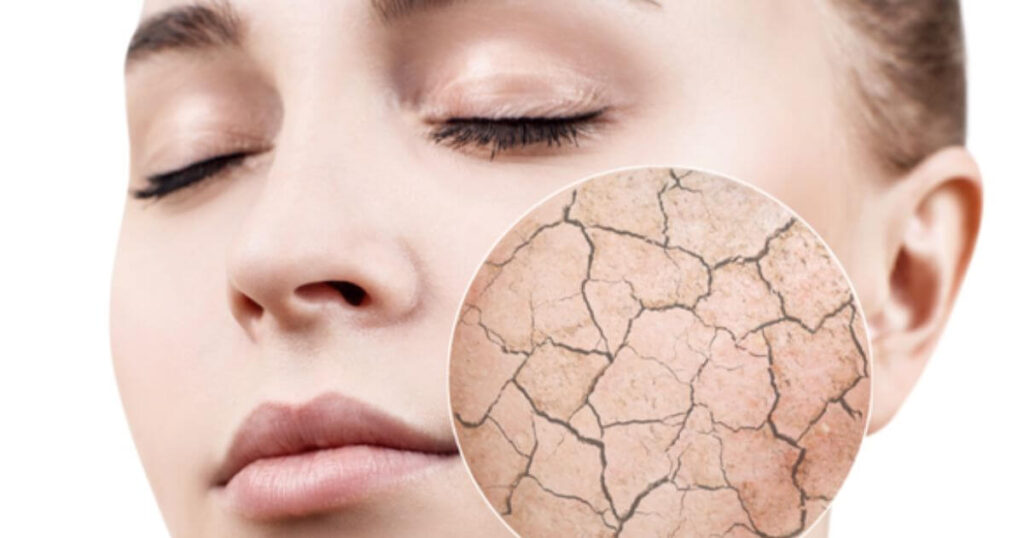 How To Treat Dry Skin On Face In Winter